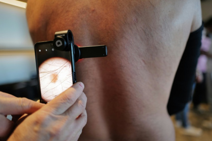 Un kiné utilise un smartphone et un dermascope pour repérer des mélanomes, le 26 septembre 2026, à Montpellier dans l'Hérault - Sylvain THOMAS (AFP)